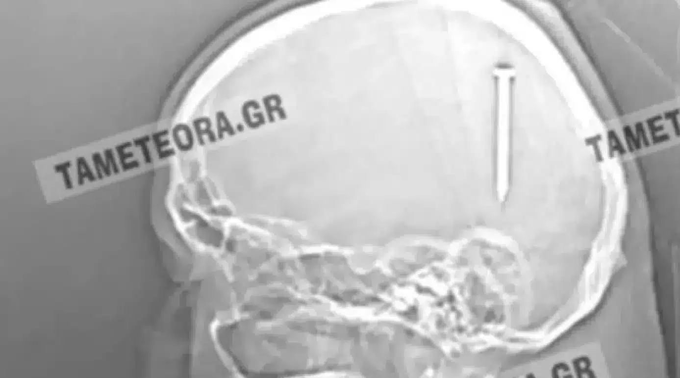 καρφι - Καρφί 5 εκατοστών σφηνώθηκε στο κεφάλι άνδρα στην Καλαμπάκα (εικόνες)