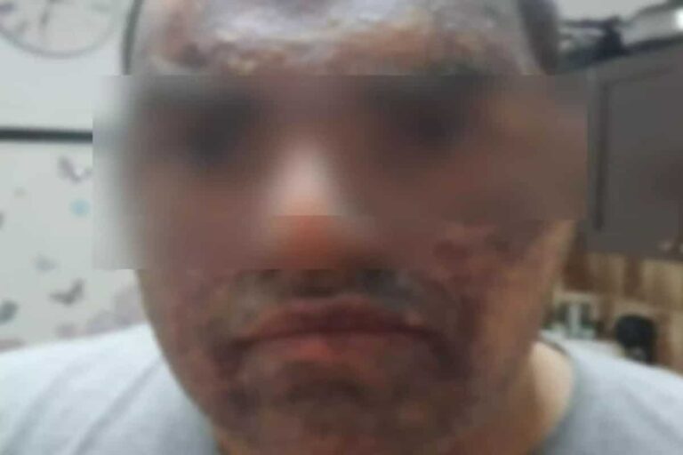 Κρήτη: «Τον άφησαν αβοήθητο» λέει η μητέρα του 22χρονου που κάηκε με λάδι ενώ εργαζόταν (βίντεο)